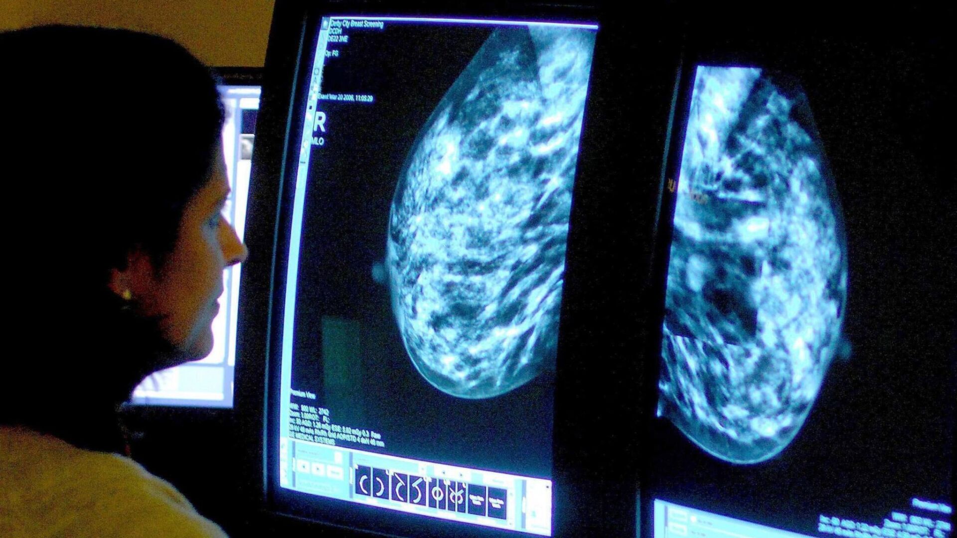 Skynews mammogram breast cancer 5329962