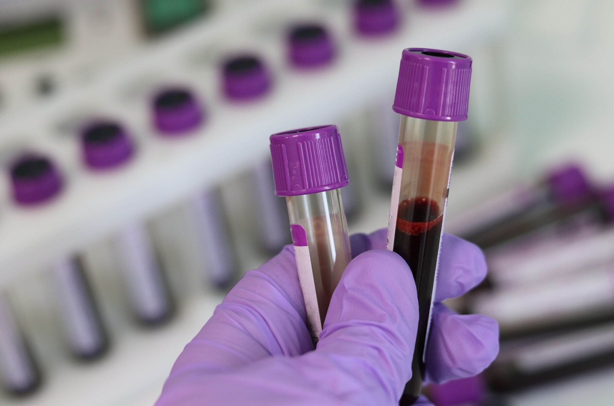 NHS to Trial Blood Test that Could Detect More than 50 Cancers main image