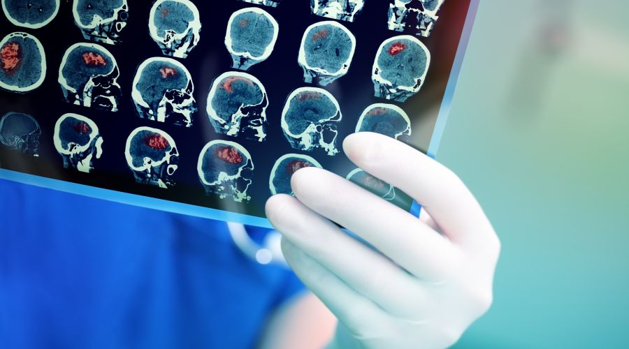 New Cancer Scan Could Guide Brain Surgery