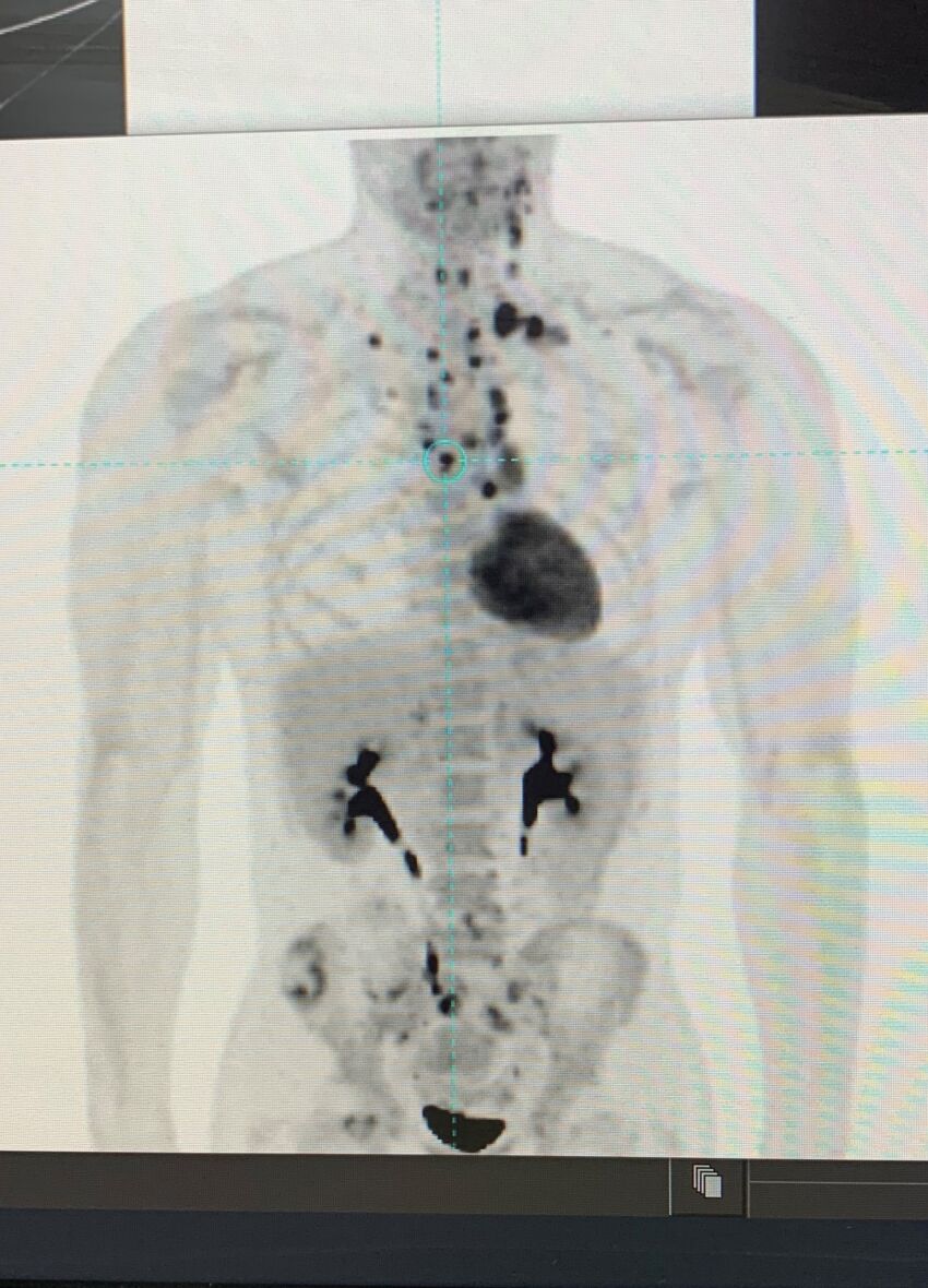 scan showing signs of hodgkins lymphoma